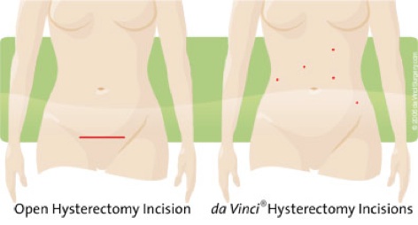 incision-comparison-hyst07-05
